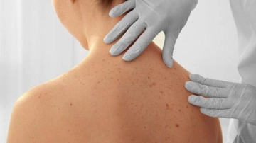 Sedef Hastalığı Çeşitleri Nelerdir?